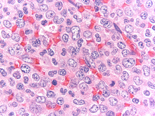 Lymph node biopsy, myeloid-predominant area, HE